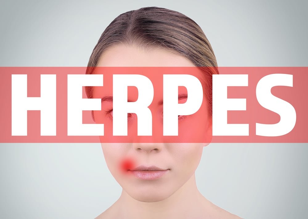 Herpes