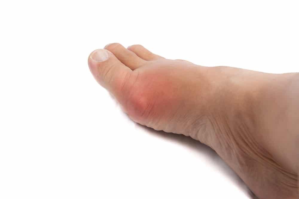 Gout: Symptoms, Causes, and Treatment