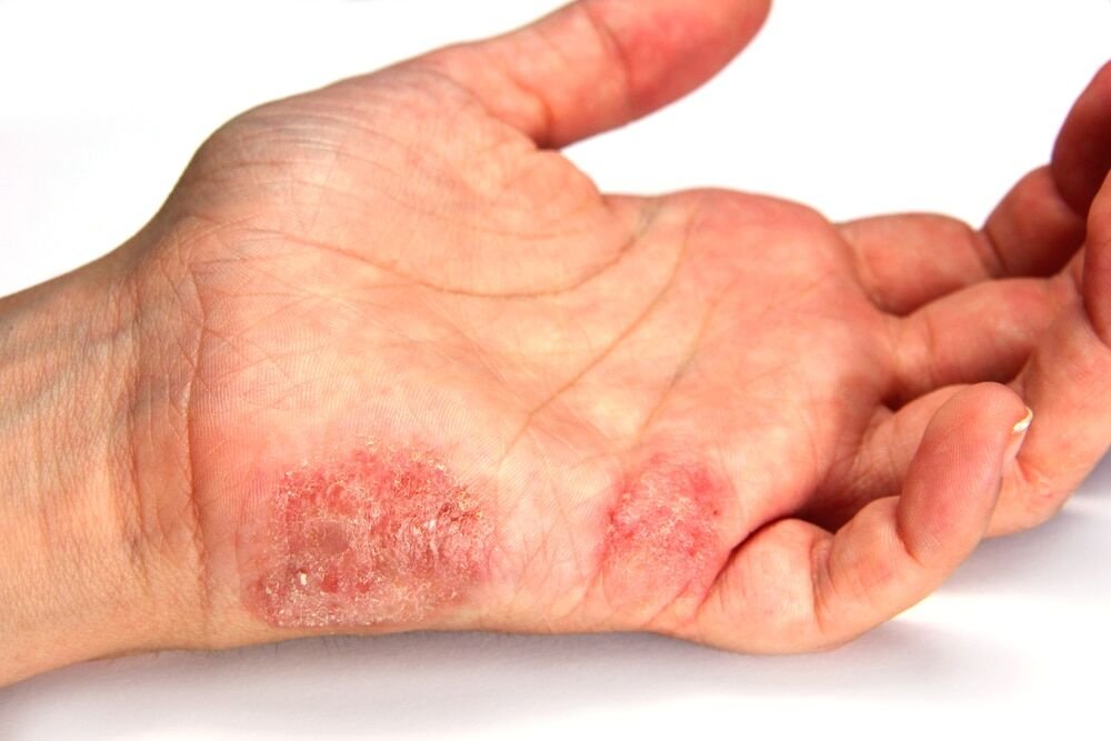 Dermatitis: Symptoms, Causes and Treatment