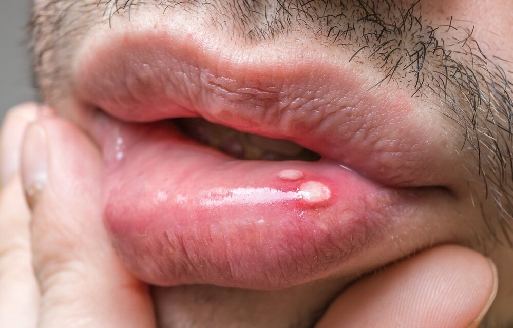 Mouth Sores: Causes, Types, Symptoms, and Treatments