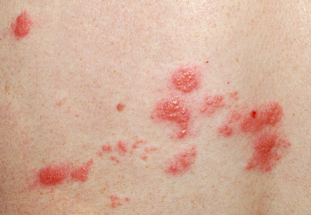 Ringworm: Symptoms, Causes, and Treatment